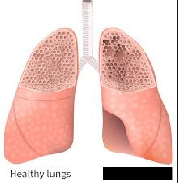 <p><span style="background-color: transparent;">A condition that affects the alveoli (the tiny air-filled pockets in the lungs responsible for gas exchange and breathing). Alveolar walls are broken down, causing alveolar spaces to become permanently and abnormally enlarged. Fewer alveolar walls lead to less surface area for gas exchange to occur, limiting airflow.</span></p>