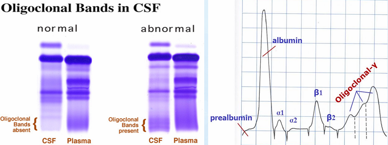 <p><strong><u>CSF protein : PROTEIN FRACTIONS</u></strong></p><ul><li><p>Agarose gel electrophoresis followed by <span style="color: red;">CBB (Commasie) staining</span> – most frequently performed</p></li><li><p><span style="color: yellow;">Methods of choice</span> when it is necessary to determine<span style="color: red;"> if the fluid is CSF</span> (“tau” identification)</p></li><li><p>Done in <span style="color: yellow;">conjunction</span> with <span style="color: red;">serum</span> <span style="color: yellow;">electrophoresis</span></p></li><li><p>For detection of <span style="color: red;">OLIGOCLONAL BAND</span></p><ul><li><p>Indicates <span style="color: yellow;">immunoglobulin production</span></p></li></ul></li></ul><p></p>