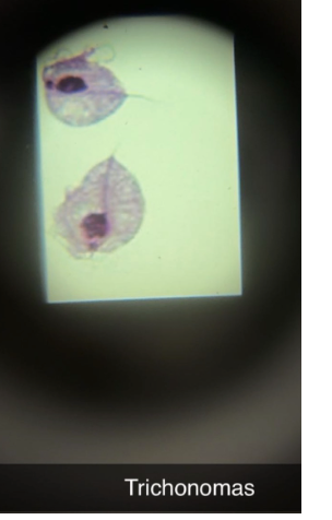 <p><span style="background-color: transparent; font-family: "Times New Roman", serif;">STD&nbsp; <em>Trichomonas vaginalis</em>&nbsp;</span></p>