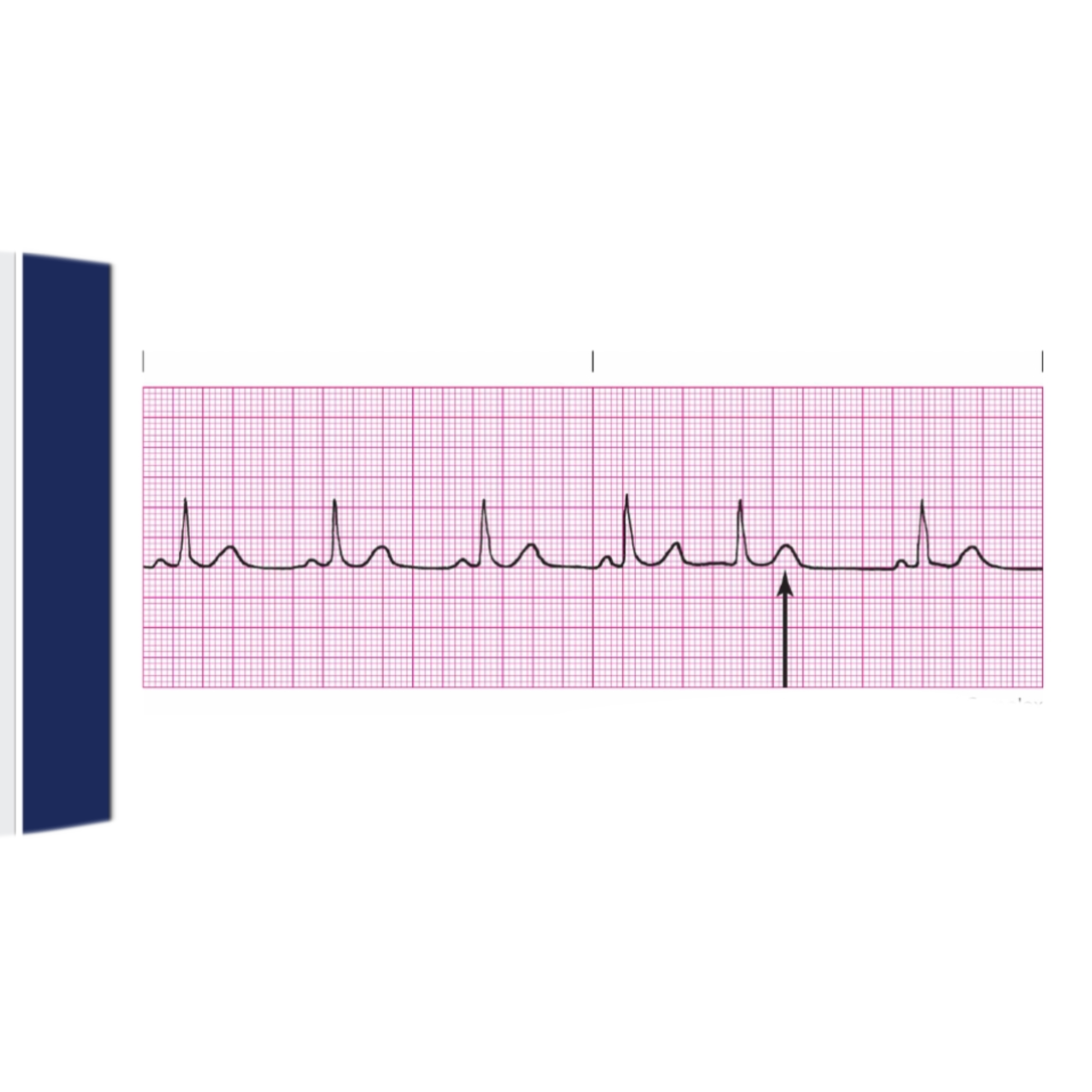 <p>Rules for Premature Junctional Complex includes</p>