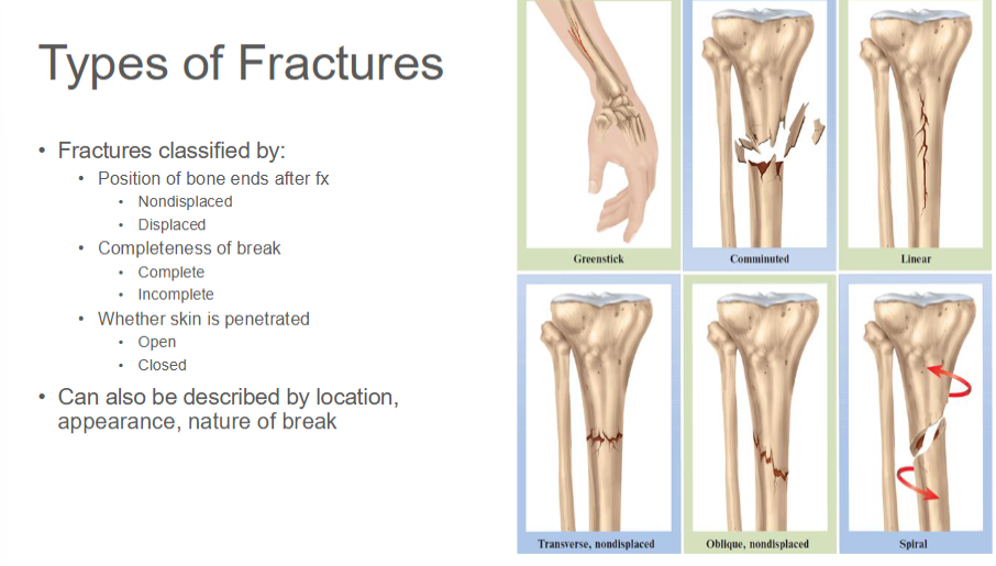 <ul><li><p>MOI</p><ul><li><p>Fracture may be direct (at point of force application) or indirect</p></li></ul></li><li><p>Classified as either closed or open</p><ul><li><p>Closed = little movement or displacement, no disruption to skin</p></li><li><p>Open = displacement of the fractured ends and breaking through the tissue</p></li></ul></li><li><p>Signs and symptoms</p><ul><li><p>Deformity</p></li><li><p>Pain</p></li><li><p>Point tenderness</p></li><li><p>Swelling</p></li><li><p>Pain with AROM & PROM</p></li><li><p>Xray necessary for diagnosis</p></li></ul></li></ul><p></p><p></p><ul><li><p>Treatment may require reduction if fx displaced</p><ul><li><p>Closed reduction</p><ul><li><p>Physician manipulates into correct postion</p></li></ul></li><li><p>Open reduciton</p><ul><li><p>Surgical pins or wires secure ends</p></li></ul></li></ul></li><li><p>Immobilization of bone with cast required for healing</p><ul><li><p>Time required depends on severity, bone that broke, age of patient</p></li></ul></li></ul><p></p>