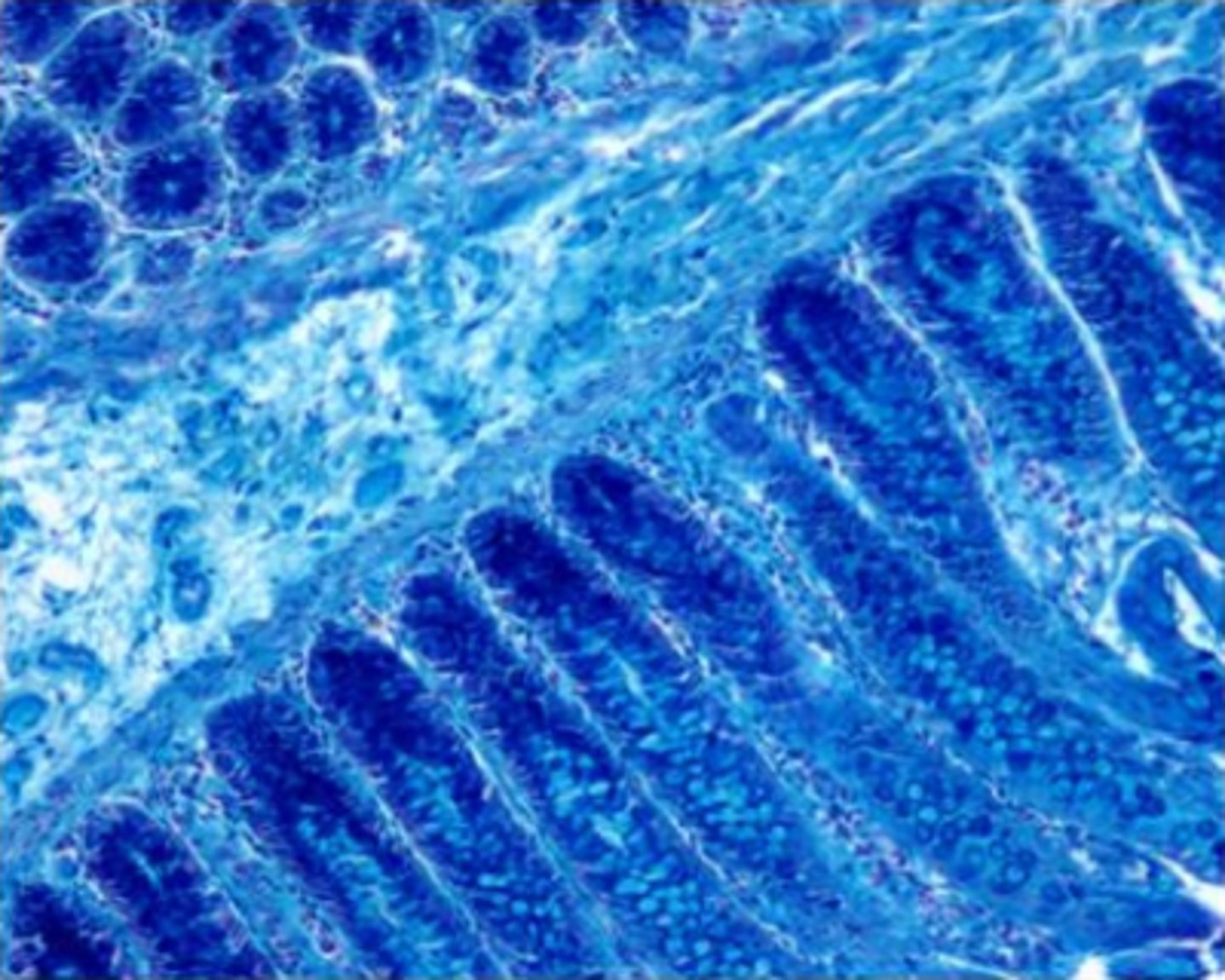 <p>marked staining of the submucosa</p><p>Feedback:</p><p>There is marked staining of the submucosa and also the lamina propria. This is improper staining. The counterstain is not the problem; this stain does not require differentiation, and a pH between 1.5 and 1.9 is proper for the colloidal iron stain.</p>