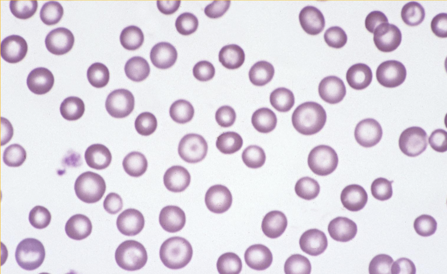 <p>anisocytosis (different RBC cell sizes)</p>