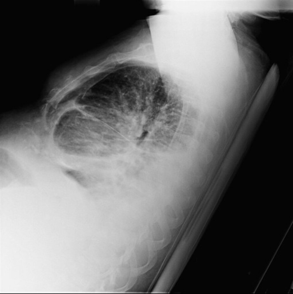 <p>RHF+ preserved systolic function, pericardium calicifed, kussmaul sign (not in tamponade), JVP, chronic condition eventually lead to RHF, dyspnea, fatigue</p><p>Causes: TB, prior caridac surgery, radiation therapy</p>