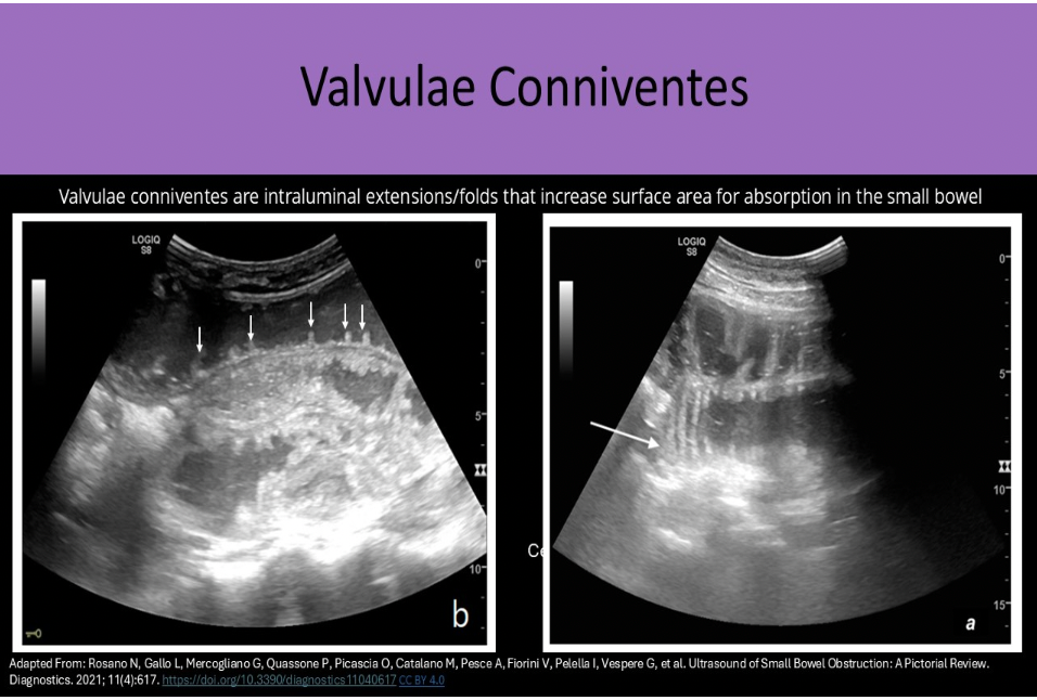 <p>A. jejunum</p><p>The jejunum is the second portion of small bowel. It contains valvulae conniventes that are intraluminal extensions/folds that increase surface area for absorption. They are abundant in proximal small bowel, but decreased in number in distal small bowel loops. The jejunum has a feathery appearance on ultrasound due to the valvulae conniventes. Valvulae conniventes are more abundant in jejunum than in distal ileum</p>