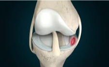 <p>Fibrocartilage Healing <br>Type l collagen </p>