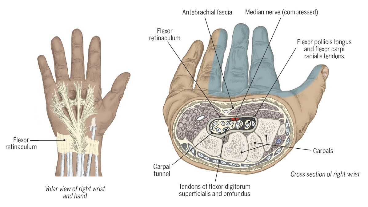 <ul><li><p>when there’s increased pressure in the carpal tunnel </p></li><li><p>decreases blood flow to small arteries that supply median nerve </p></li></ul><p></p>
