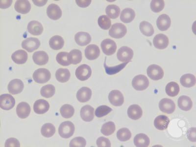 <p>Drepanocyte</p>