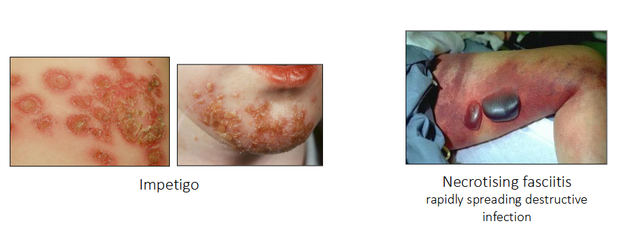 <p>- Impetigo</p><p>- Necrotising fasciitis (rapidly spreading destructive infection)</p>