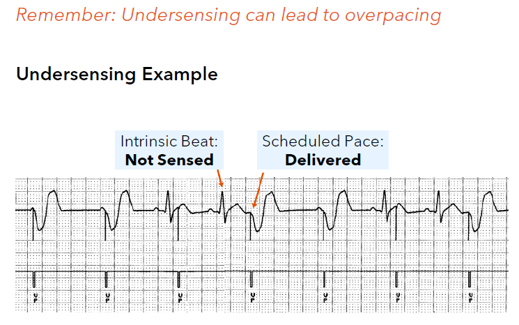 <p>a device does not “see” an intrinsic depolarization and therefore does not respond appropriately</p><p>With undersensing, the device does not accurately see intrinsic depolarizations and may fail to inhibit pacing.</p>
