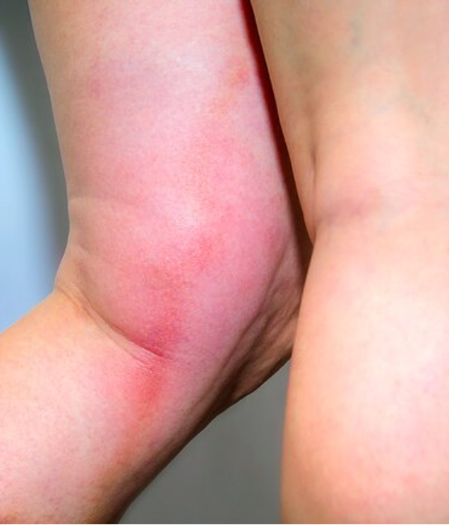 <ul><li><p><strong>edema </strong></p></li><li><p><strong>erythema/warmth</strong></p></li><li><p><strong>pain</strong></p></li><li><p>homan’s sign may be positive</p></li><li><p>palpable indurated cord-like vein (rope-like structure)</p></li></ul><p></p>