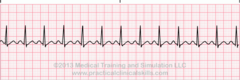 <p>-*P for every QRS*</p><p>-QRS narrow </p><p>-Regular </p><p>-*Rate >100 bpm*</p>