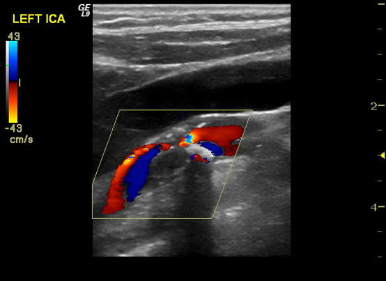 <p>What pathology is being shown in this image?</p>