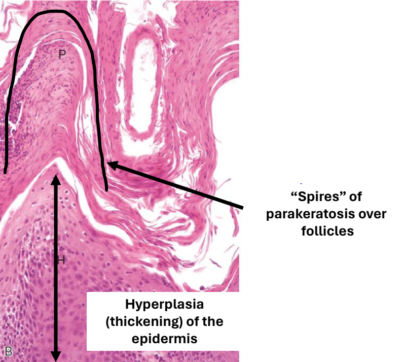 <ul><li><p>distribution of infiltrate: superficial</p></li></ul><ul><li><p><strong>lymphocytic</strong> infiltrate</p></li><li><p>epidermal changes: hyperkeratosis (parakeratosis)</p></li></ul><p></p>