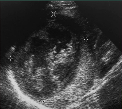 <p>Bleeding within simple cyst, hematocrit levels drop, Repeated episodes of bleeding may result in calcification within the cyst</p>