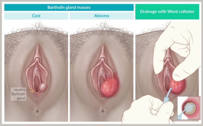 <p>Fluid or pus-filled lumps forming on/near the external genitalia or vaginal walls</p><p><strong><u>Types</u></strong>:</p><ol><li><p><strong>Bartholin Cyst</strong>: mucus-producing Bartholin glands on inner sides of labia become inflamed/blocked, causing swelling, cyst and abscess (Mx = incision/drain)</p></li><li><p><span><strong>Vaginal Inclusion Cysts:</strong> most common type of vaginal cyst, typically caused by trapped skin tissue (epithelium) following childbirth injuries or surgery</span></p></li><li><p><span><strong>Epidermal & Sebaceous Cysts:</strong> Often found on the vulva, formed when oil-producing sebaceous glands or hair follicles become blocked</span></p></li><li><p><span><strong>Gartner’s Duct Cysts:</strong> Form on the vaginal walls from remnants of embryonic development (the Müllerian or mesonepheric ducts)</span></p></li></ol><p></p>