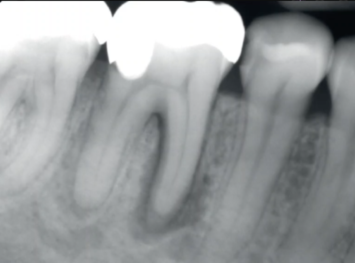 <p>what is the appropriate first managment after irriversible pulpitis diagnosis </p>