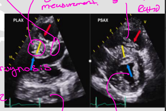 <p>Wall thickness should be measured in <strong>multiple views</strong>. PLAX &amp; PSAX</p><p>you take the septal wall and posterior wall and divide it to find the ratio to see is if it is associated with HCM</p><p><strong>High-yield numbers:</strong></p><ul><li><p>Septal/posterior wall ratio: <strong>>1.3 cm</strong></p></li><li><p>Septal thickness sudden death risk: <strong>>3.0 cm</strong></p></li><li><p>Risk listed: <strong>40% cumulative risk</strong></p></li></ul><p>yellow line is accurate measurement</p>