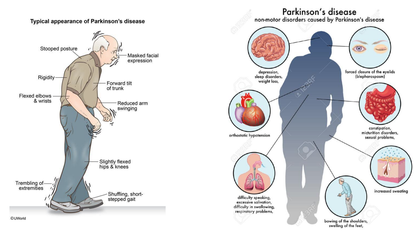 <p><strong>PD symptoms (motor + non-motor)</strong></p>