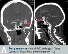 <p>ruptured aneurysm caused by a traumatic injury. this increases the risk of vasospasm.</p>