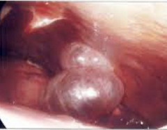 <p>only known cause of a spontaneous pneumothorax, caused by ruptures of these air filled sacks</p><p>risk factors: smoking, tall and thin stature, male, genetics, prior occurrence</p>