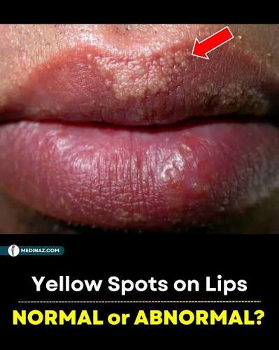 <ul><li><p>80% of adults appear at puberty </p></li><li><p>Ectopic sebaceous gland </p></li></ul><p></p>
