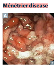 <p>Hyperplasia of gastric mucosa p hypertrophied rugae (“wavy” like brain gyri). Causes excess mucus production with resultant protein loss and parietal cell atrophy with r acid production. </p>