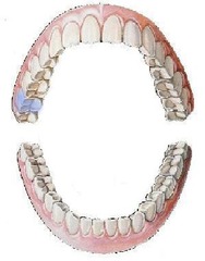 <p>maxillary right second molar</p>