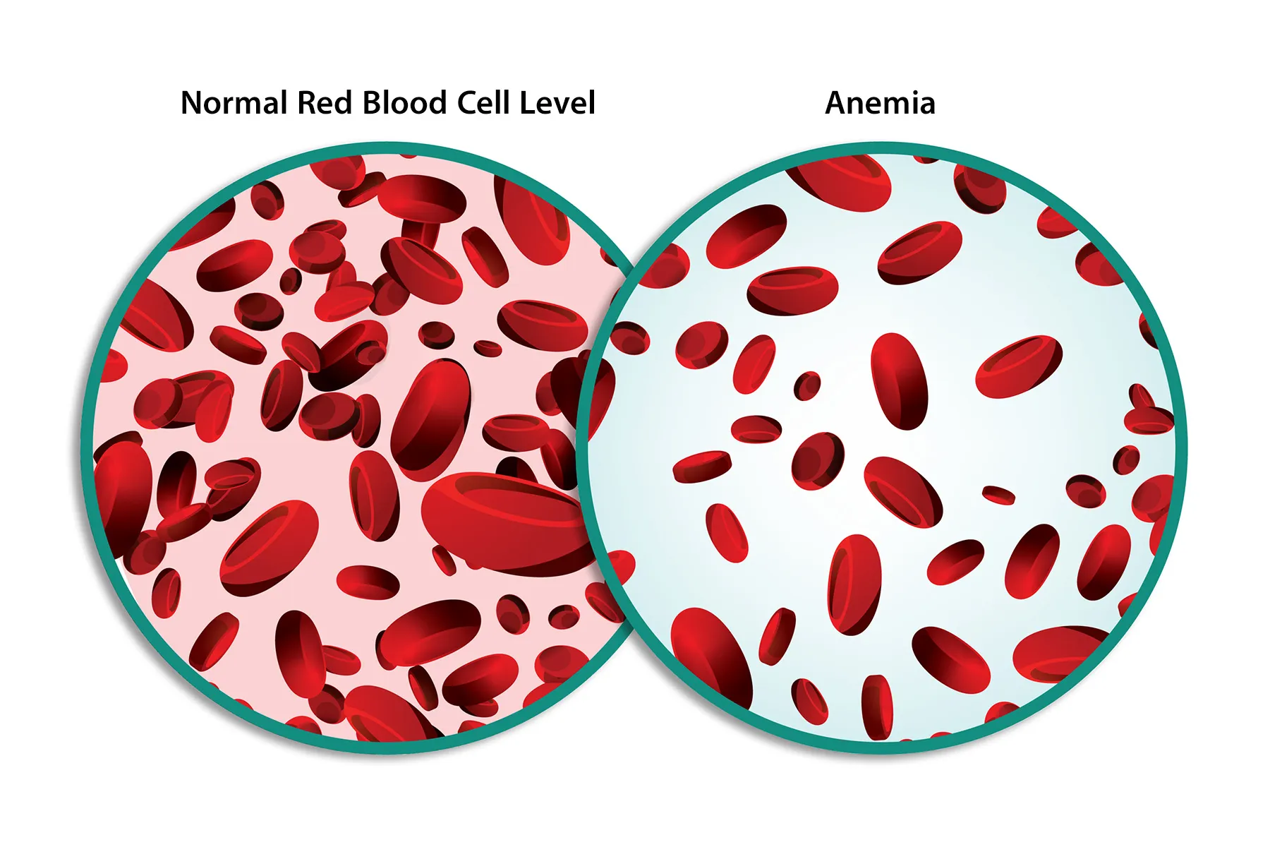 <p><strong>Anemia</strong></p>