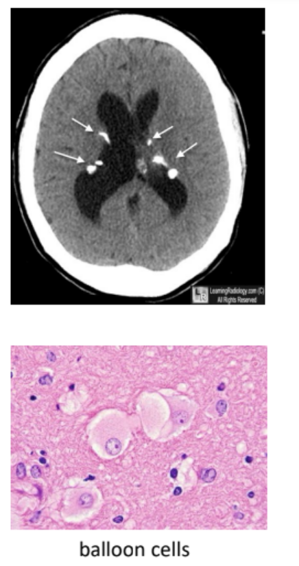 <p>true</p><p>__</p><p>a rare autosomal dominant disorder that is secondary to mutations in the TSC1 and TSC2 tumor suppressor genes</p><ul><li><p>associated with formation of <strong><u>hamartomas </u></strong>(<u>non-cancerous tumors</u>)</p></li><li><p>symptoms:</p><ul><li><p>seizures</p></li><li><p>autism</p></li><li><p>intellectual disability</p></li></ul></li></ul><p></p>