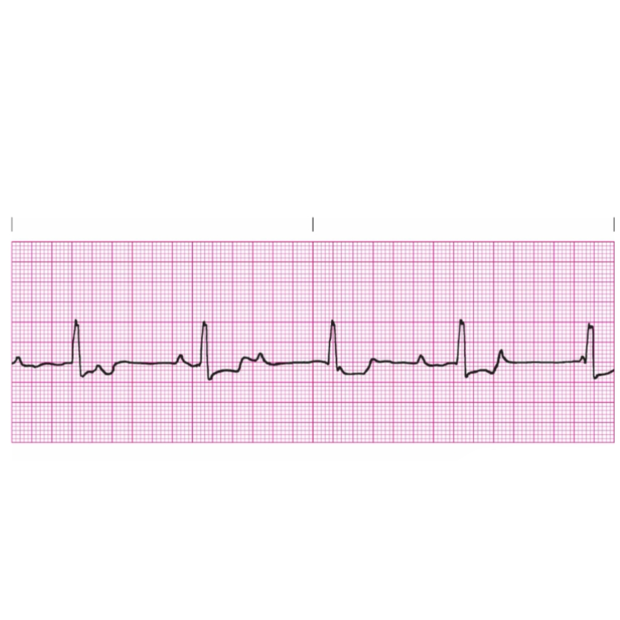 <p class="is-empty is-editor-empty has-focus">Rules for Complete Heart Block</p>