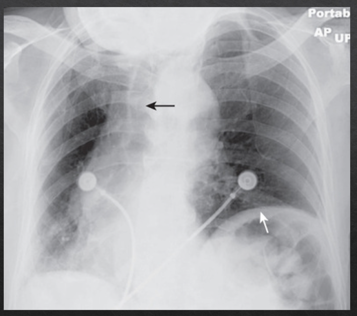<ul><li><p>trachea appears shifted from midline (black arrow)</p></li><li><p>left lung appears much larger, right lung appears smaller</p></li><li><p>heart contour appears changed </p></li><li><p>left hemidiaphragm appears raised (white arrow)</p></li></ul><p></p>
