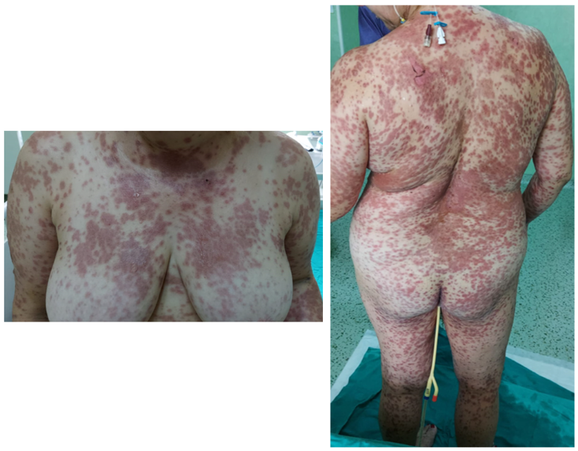 <p>Toxic Epidermal Necrolysis (TEN)</p>