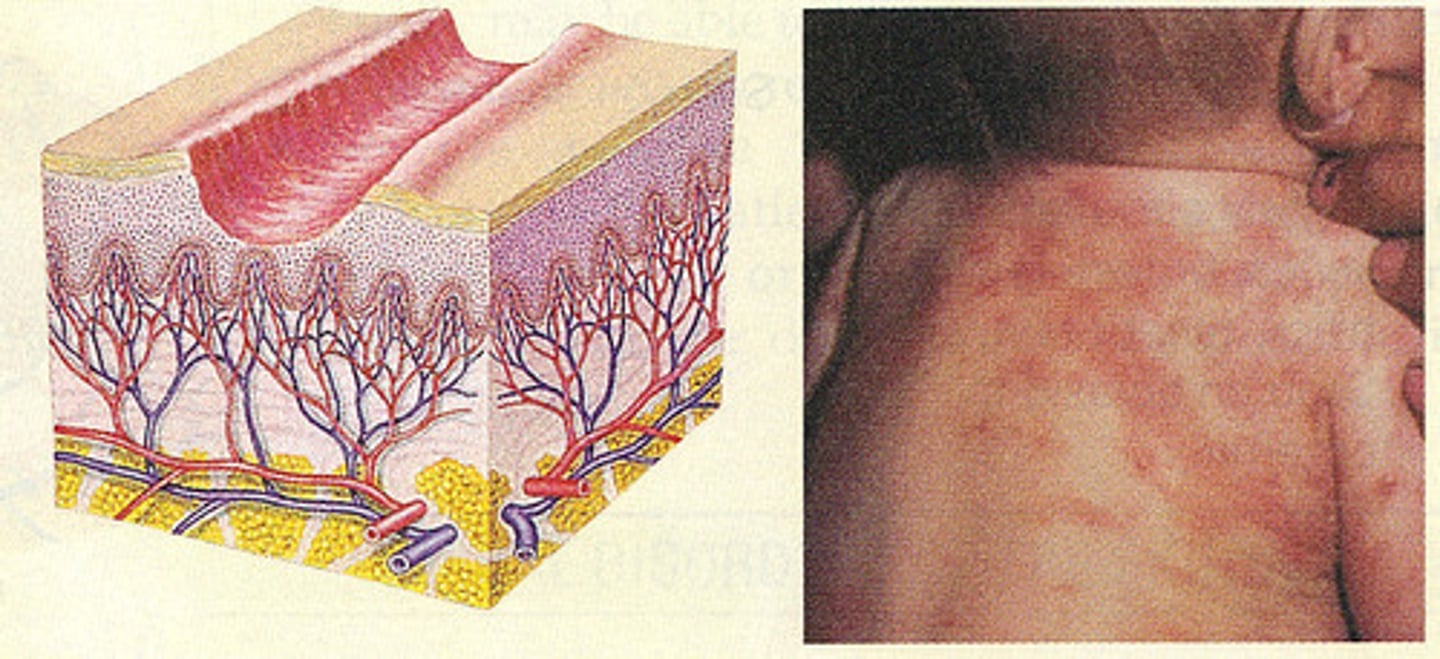 <p>is a crack in the skin penetrating into the dermis.</p>