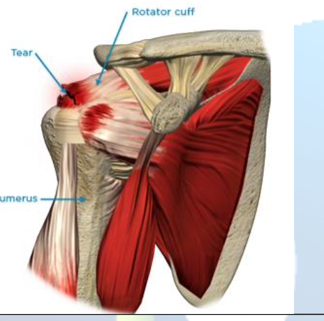<p>Rotator Cuff Rupture</p>