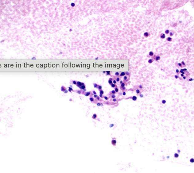 <p>Kyste du pancreas </p><p>1) diagnostic</p><p>2) morphologie + colorations spéciales</p><p>3) biochimie</p><p>4) altérations moléculaire</p><p>5) risque de malignité </p>