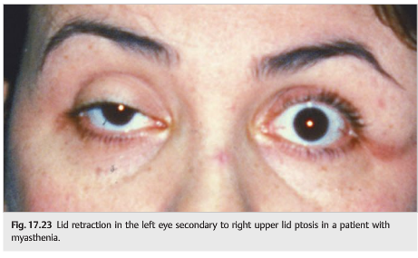 <p>abnormal white rim of sclera visible between upper eyelid and iris when a person moves the eyes downward</p>
