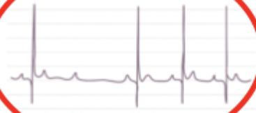 <p>What rhythm is shown?</p>