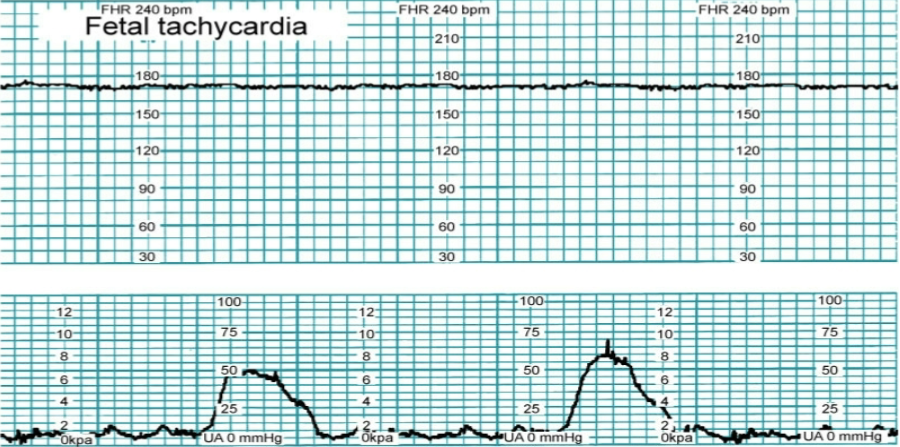 <p>nursing interventions for FHR tachycardia</p>