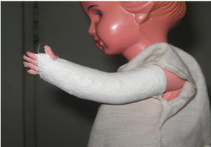 <p><span>fracture of radius and ulna</span></p>