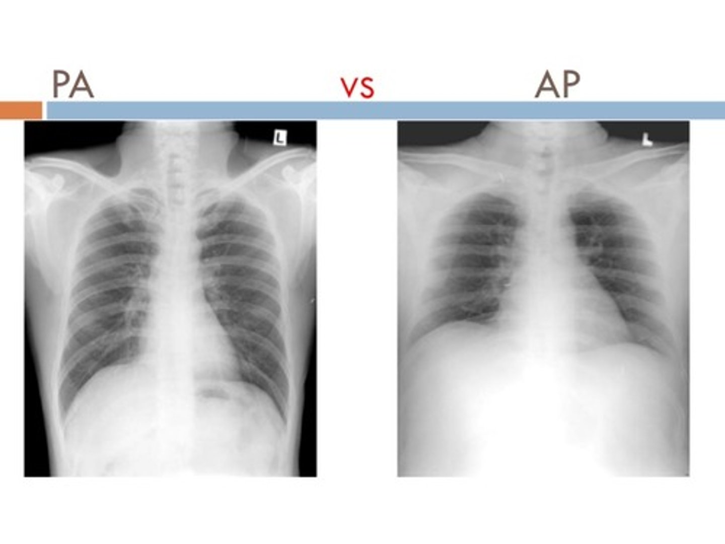 <p>AP (anteroposterior)</p>