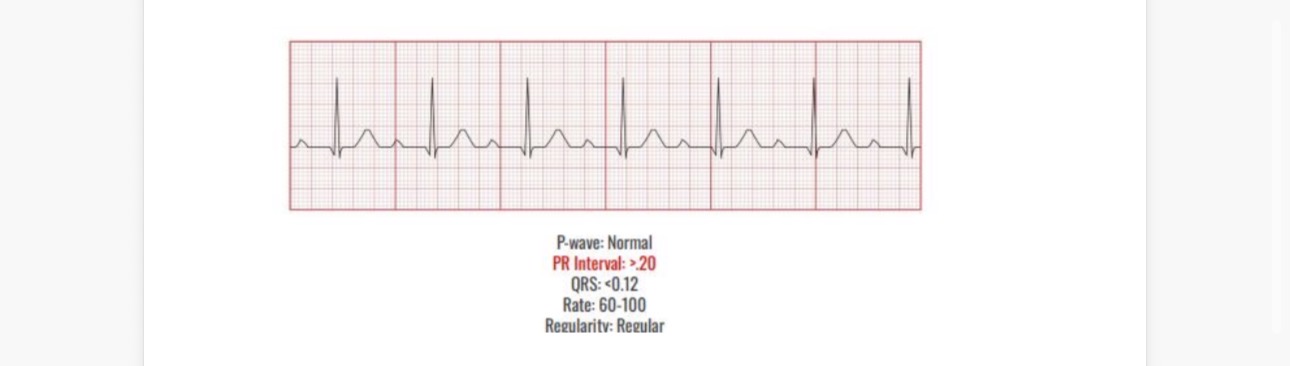 <p>Causes</p><p>Peds- infection</p><p>Myocarditis</p><p>Congenital heart disease</p><p></p><p>Intervention</p><p>Fix the cause</p><p>Treatments is not generally required</p><p>If extreme pacing</p><p></p>