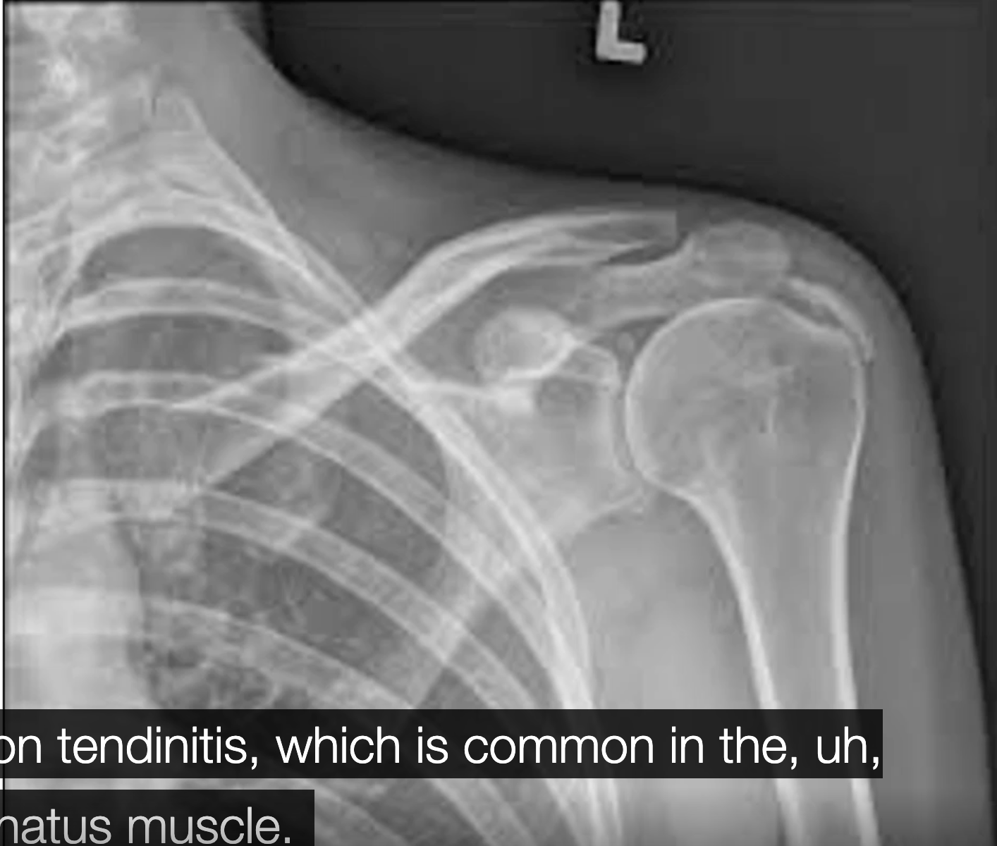 <ul><li><p><span>Deposits of calcium in tendons of rotator cuff</span></p><ul><li><p><span>Pain and reduced ROM</span></p></li><li><p><span>Supraspinatus common</span></p></li></ul></li></ul><p></p>