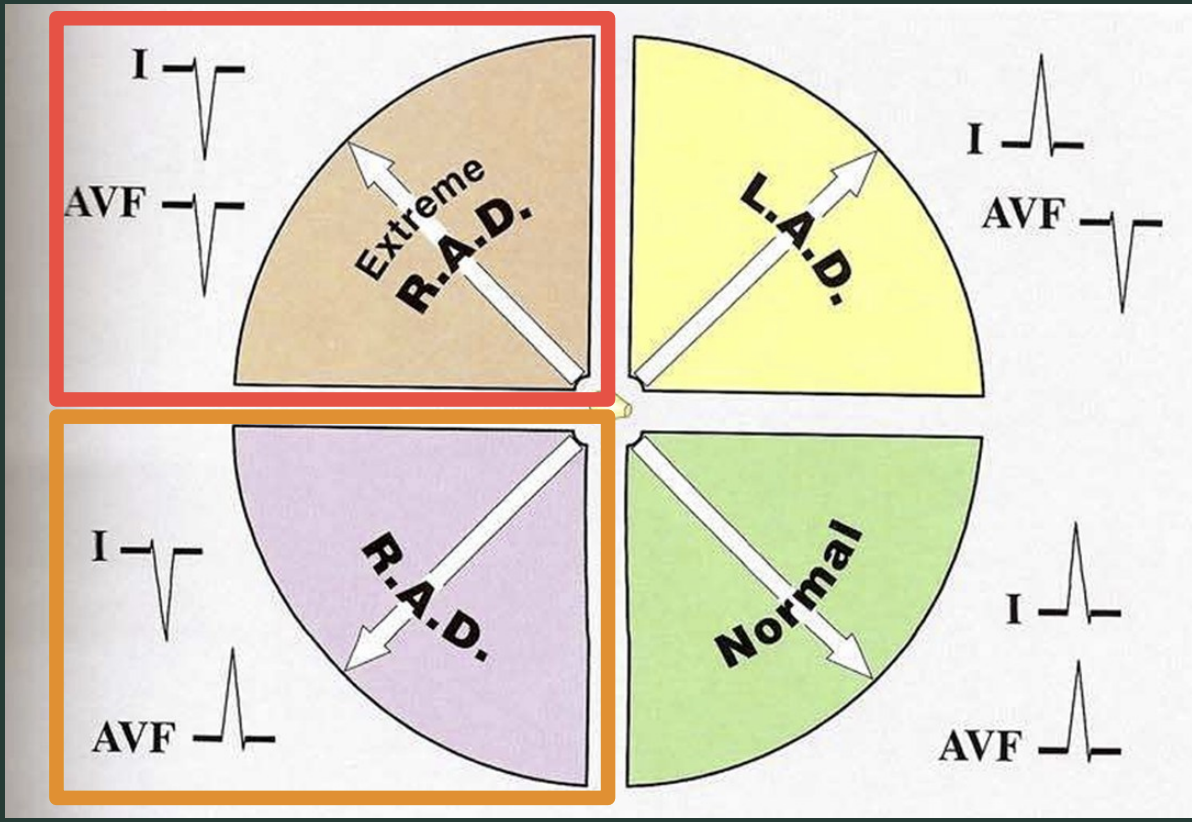 <p>positive in both lead I and aVF</p>