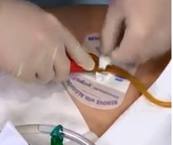 <p>leaves a little slack, secure at cath bifurcation</p>