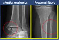 <p>- point tenderness at malleolus</p><p>- swelling</p><p>- pain with walking</p>