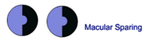 <ul><li><p>The central 30º visual field is represented by approximately 80º of the striate cortex</p></li><li><p>Macular sparring is difficult to demonstrate clinically.</p></li><li><p>Hard to image on a 30-2 or 24-2 as the stimuli are 6º apart. However a 10-2 grid (2º apart) and Amsler grid have enough resolution to demonstrate macular sparing</p></li></ul><p></p>