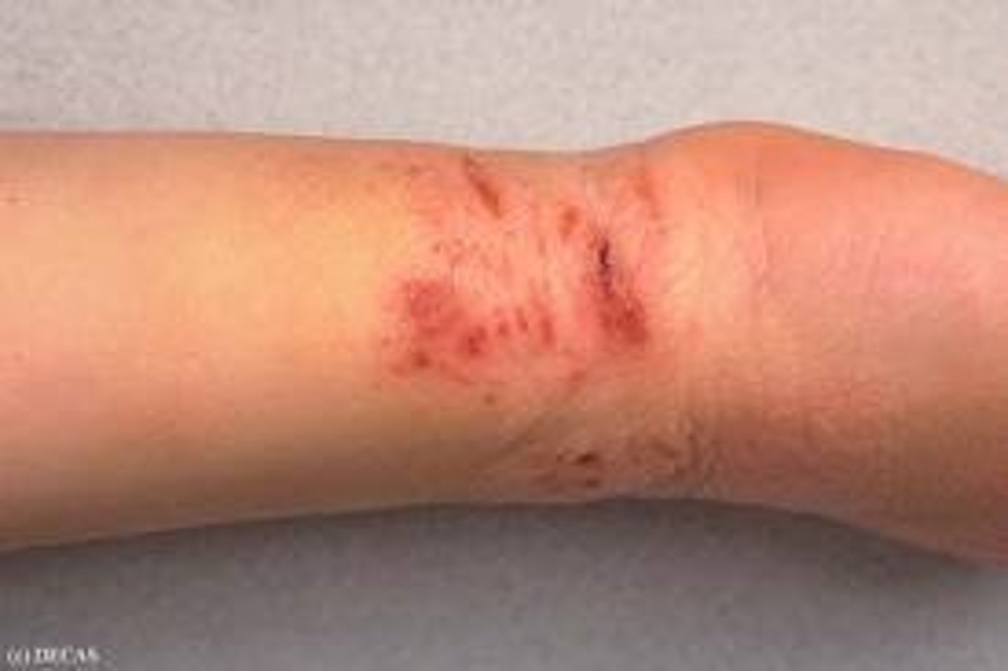 <p>Skin sore or abrasion produced by scratching or scraping</p>