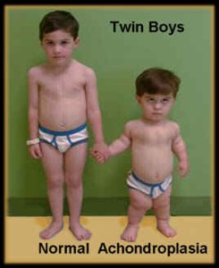 <p>pituitary dwarfism</p>