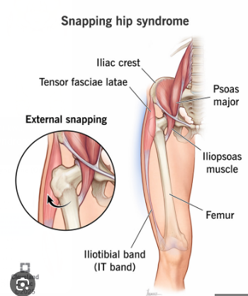 <p><span style="color: red;"><strong>Snapping Hip Syndrome</strong></span></p>